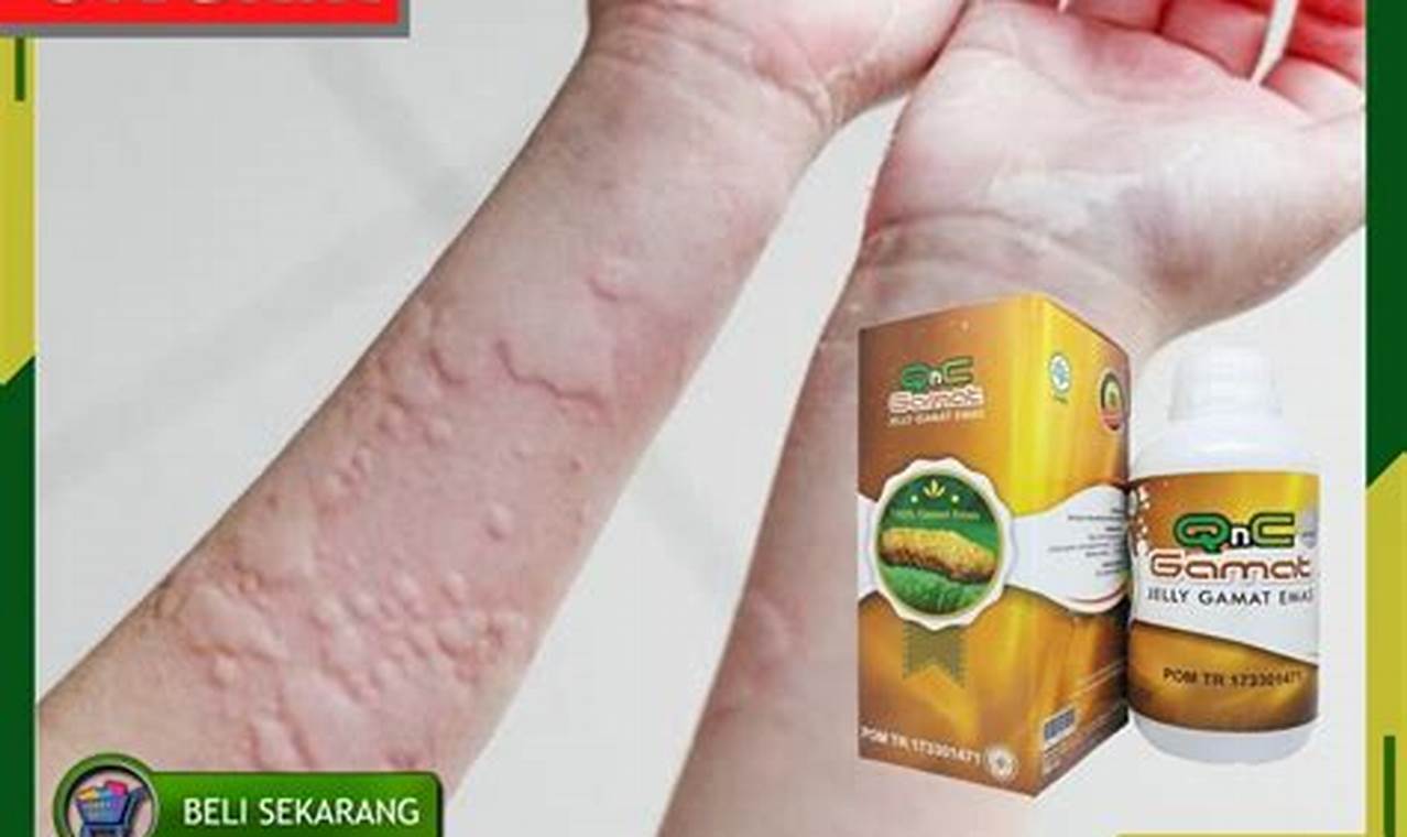 Cara Mengatasi Kaligata Dengan Mudah Dan Efektif